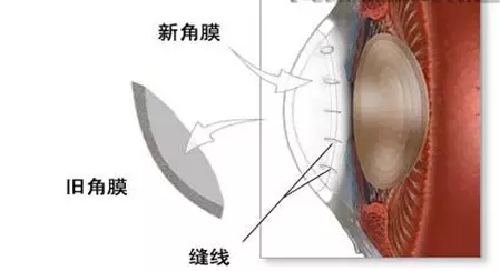 一眼萬(wàn)年幾度輪回：華德眼科角膜移植全攻略