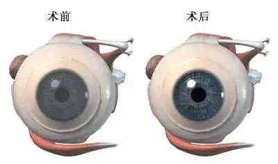 一眼萬(wàn)年幾度輪回：華德眼科角膜移植全攻略