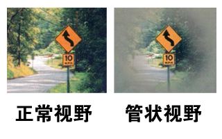 當(dāng)青光眼遇上白內(nèi)障，這場(chǎng)防盲保衛(wèi)戰(zhàn)該怎么打？