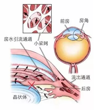 當(dāng)青光眼遇上白內(nèi)障，這場(chǎng)防盲保衛(wèi)戰(zhàn)該怎么打？
