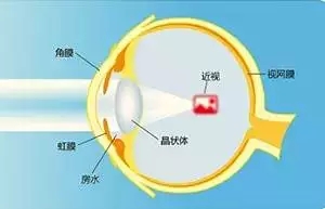 【ICL人工晶體植入術】跟高度近視眼如何“接軌”？