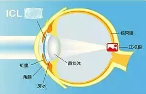 【ICL人工晶體植入術】跟高度近視眼如何“接軌”？