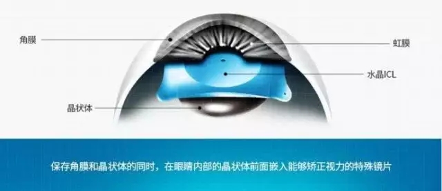 高度近視？ICL可幫您擺脫各種眼鏡 ！