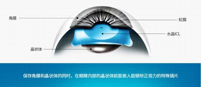ICL高度近視的優點