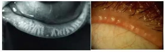 眼睛干澀痛，一查竟角膜上皮損傷嚴(yán)重、腺體萎縮！