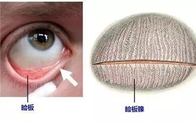 眼睛干澀痛，一查竟角膜上皮損傷嚴(yán)重、腺體萎縮！