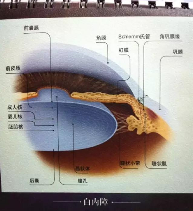 眼科醫生：白內障早期癥狀和應對方法