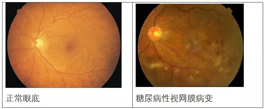患了“糖尿病”后，該做哪些眼科檢查？