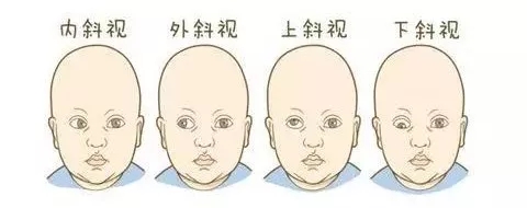 孩子斜視弱視不及時(shí)，導(dǎo)致毀一生？專(zhuān)家告訴您真相！