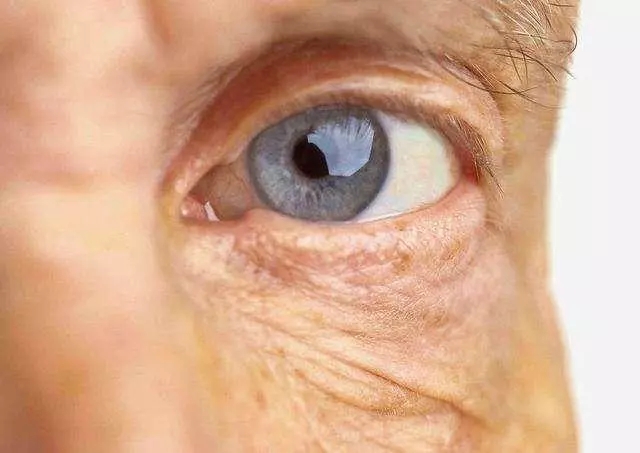 黃斑變性或致致盲：50歲以上人群每年都應檢查