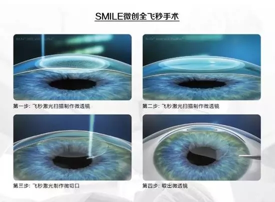 近視手術已經(jīng)進入“綠色全飛秒時代”