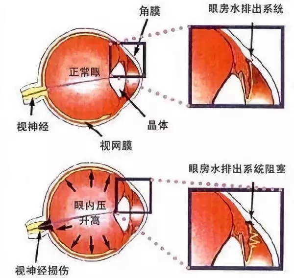 頭暈眼花，不一定是感冒，還可能是眼疾！