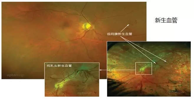 非接觸、免散瞳、超廣角眼底檢查不是夢！