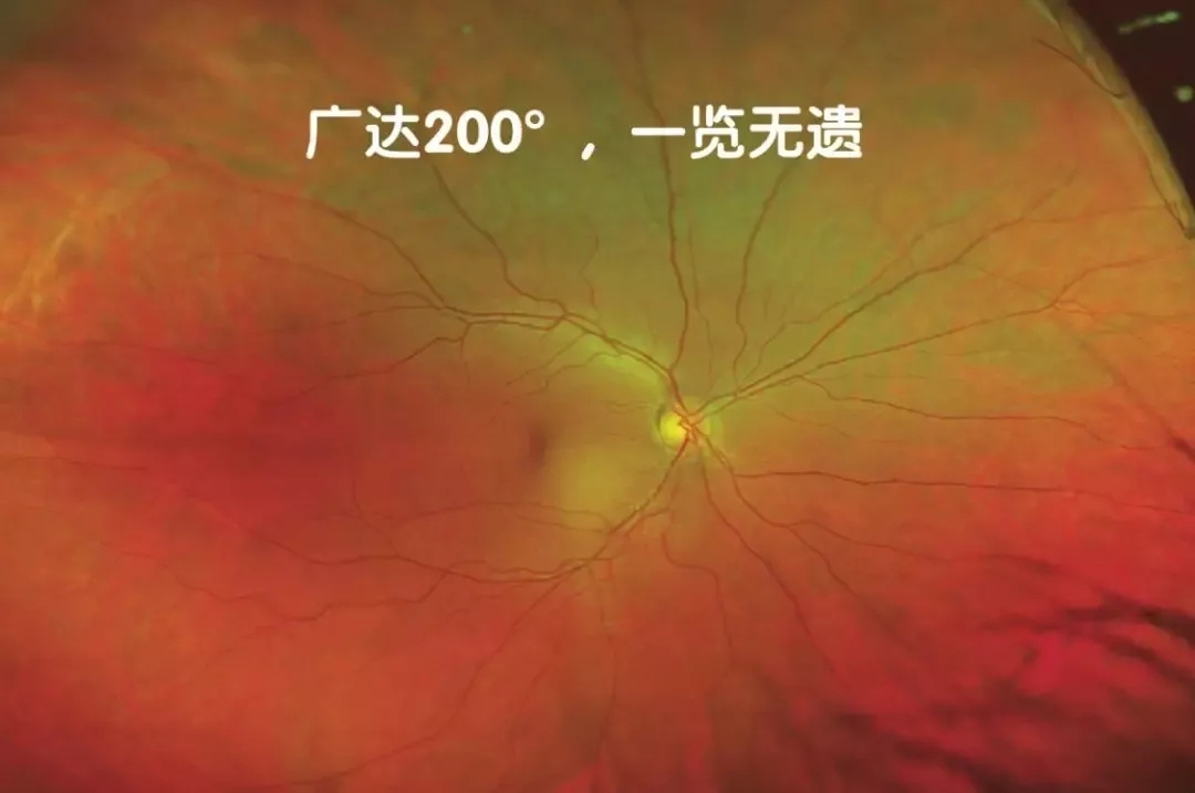 非接觸、免散瞳、超廣角眼底檢查不是夢！